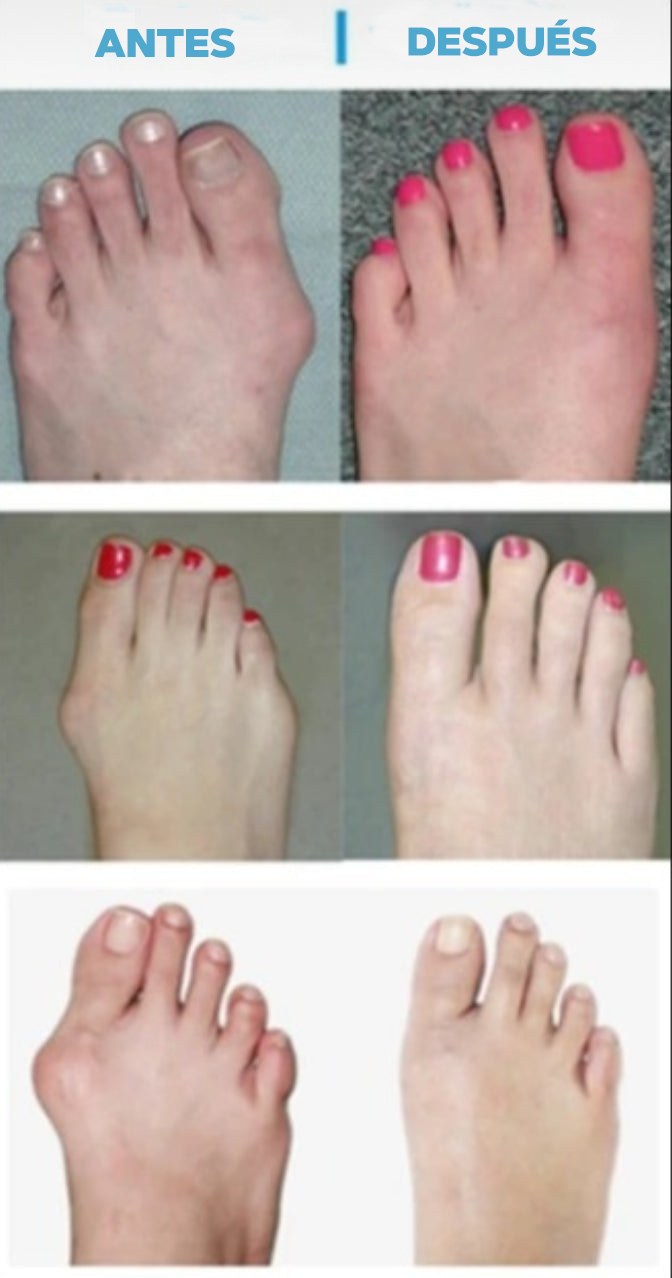 CALCETIN CORRECTOR DE JUANETES PREMIUM - HALLUXVALGUS™