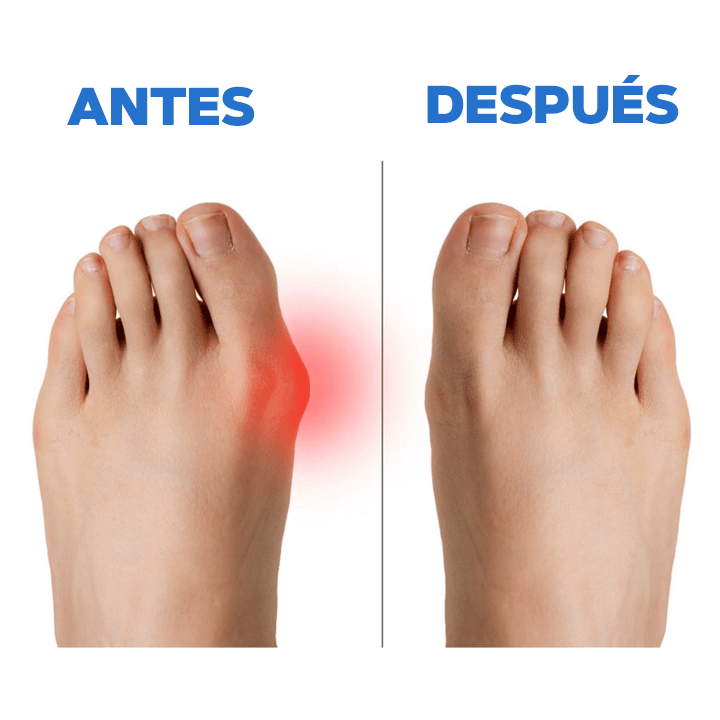 CALCETIN CORRECTOR DE JUANETES PREMIUM - HALLUXVALGUS™
