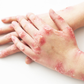 SPRAY CONTRA LA PSORIASIS - NOTPSORIASIS™