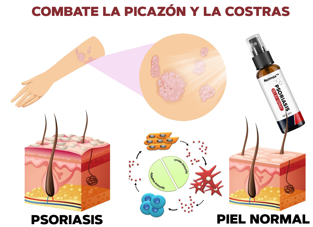 SPRAY CONTRA LA PSORIASIS - NOTPSORIASIS™