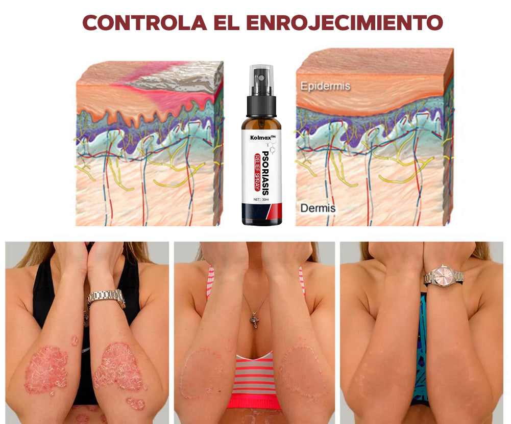 SPRAY CONTRA LA PSORIASIS - NOTPSORIASIS™