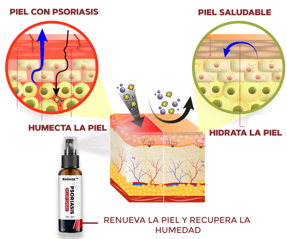 SPRAY CONTRA LA PSORIASIS - NOTPSORIASIS™