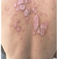 SPRAY CONTRA LA PSORIASIS - NOTPSORIASIS™