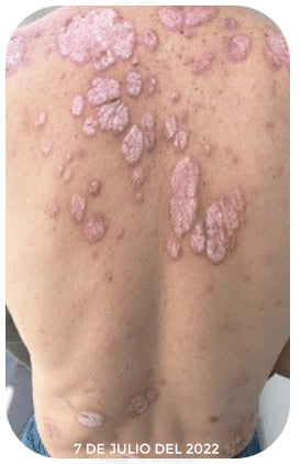 SPRAY CONTRA LA PSORIASIS - NOTPSORIASIS™