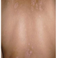 SPRAY CONTRA LA PSORIASIS - NOTPSORIASIS™