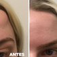 CREMA ELIMINADORA DE LIPOMAS - LIPOMFREE™