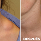 CREMA ELIMINADORA DE LIPOMAS - LIPOMFREE™