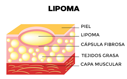 CREMA ELIMINADORA DE LIPOMAS - LIPOMFREE™