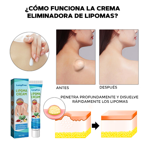 CREMA ELIMINADORA DE LIPOMAS - LIPOMFREE™