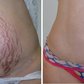 Spray para cicatrizes - ScarRemove™
