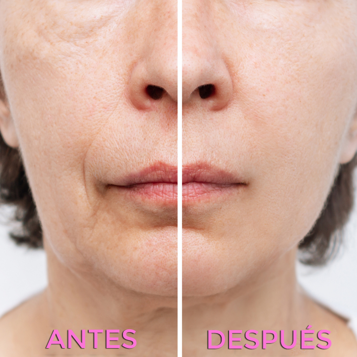 Parches Correctores de Arrugas - BeautySkin™