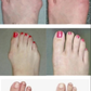 CALCETIN CORRECTOR DE JUANETES PREMIUM - HALLUXVALGUS™