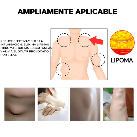 CREMA ELIMINADORA DE LIPOMAS - LIPOMFREE™