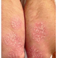 SPRAY CONTRA LA PSORIASIS - NOTPSORIASIS™