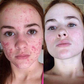 Spray para cicatrizes - ScarRemove™