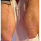 SPRAY CONTRA LA PSORIASIS - NOTPSORIASIS™