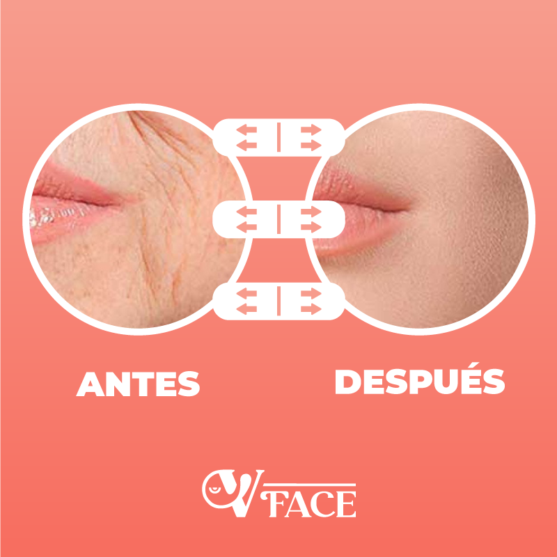 Cinta levantadora de rostro - VFace™