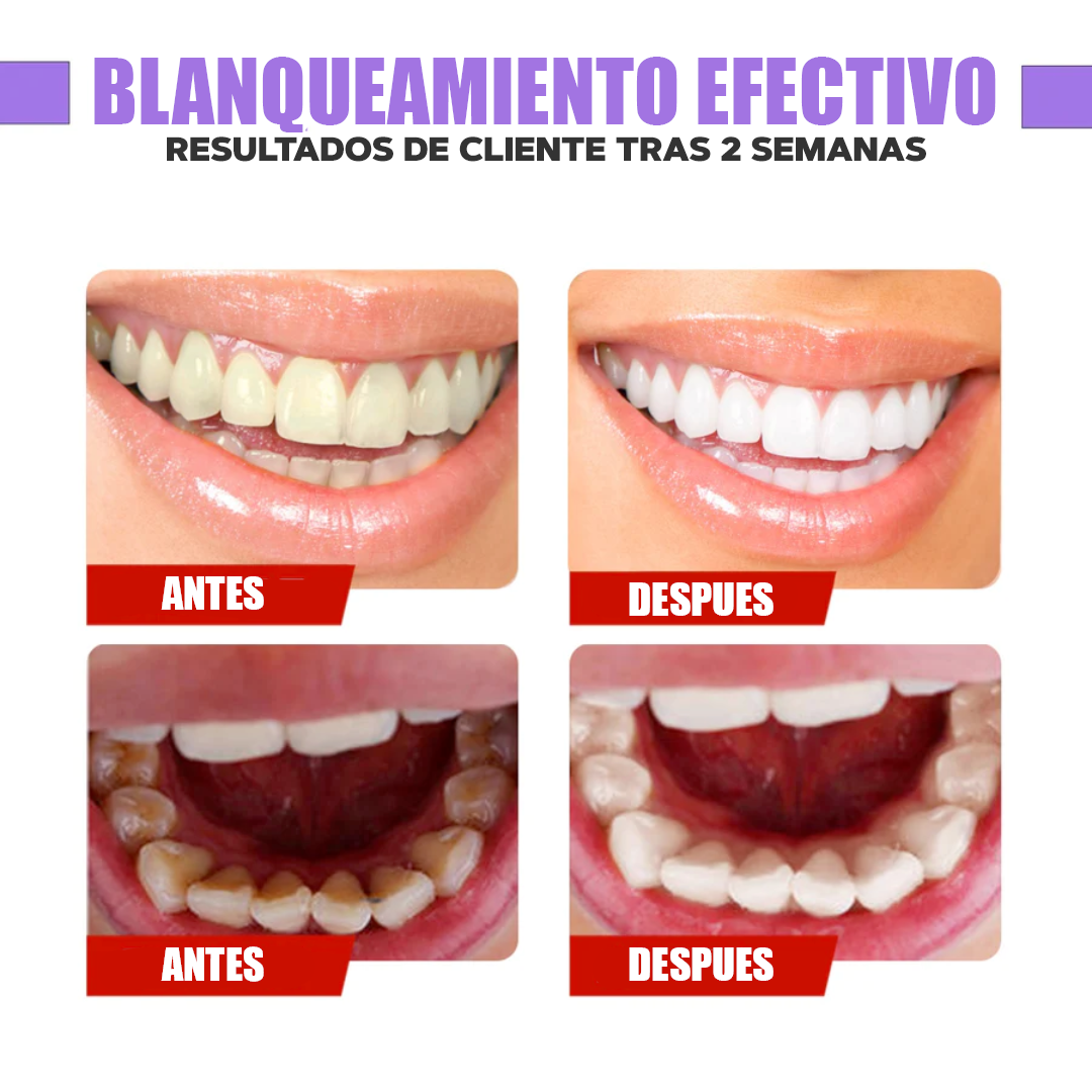 BLANQUEADOR DE DIENTES - HAPPYSMILE™